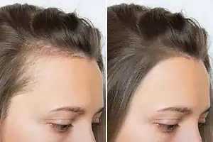 Hair restoration treatment results for natural-looking hair growth.